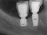 Bicon SHORT Dental Implant Radiograph 0088