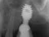 Bicon SHORT Dental Implant Radiograph 0089