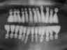 Bicon SHORT Dental Implant Radiograph 0090