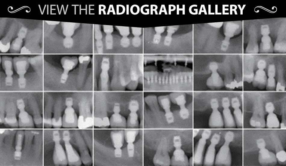 Short Dental Implant Radiographs