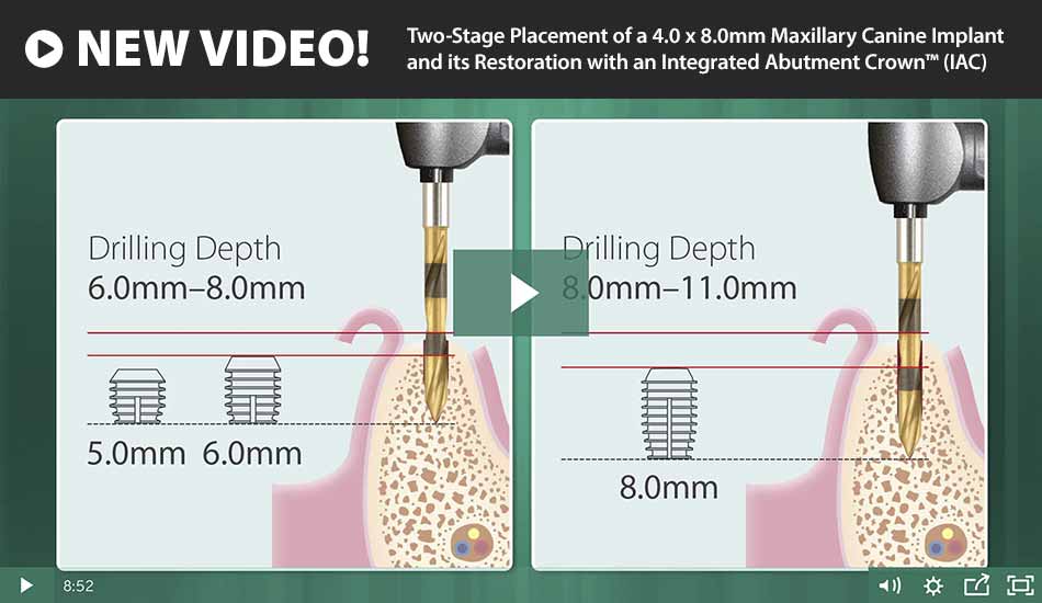 Two-Stage Placement of a 4.0 x 8.0mm Maxillary Canine Implant and its Restoration with an Integrated Abutment Crown™ (IAC)