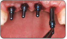 2. Insert a red 2.0mm titanium impression post into the implant well, using finger pressure.