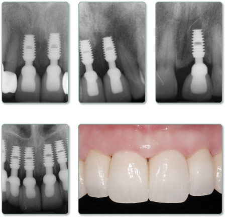 MAX 2.5™ Implant Clinical Images